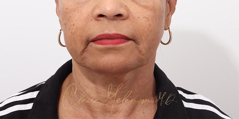 Facelift Before & After Photo