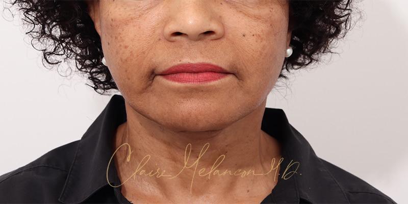 Facelift Before & After Photo