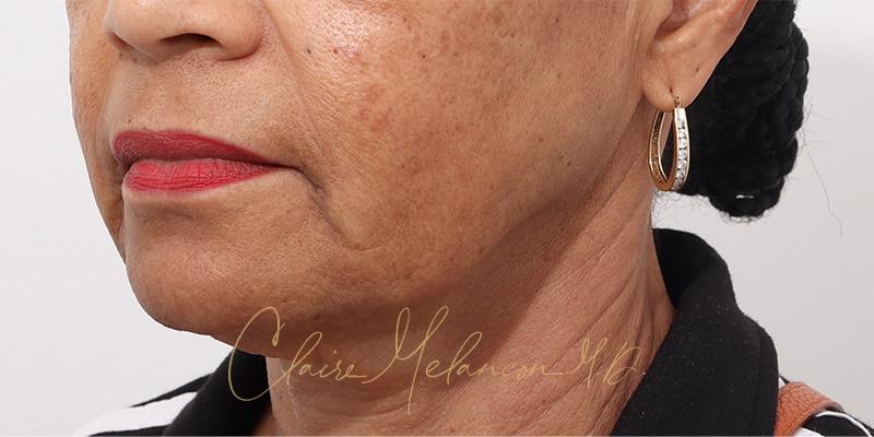 Facelift Before & After Photo