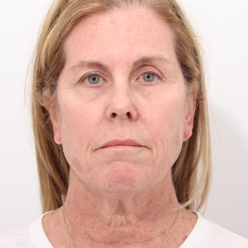 Facelift Before & After Photo