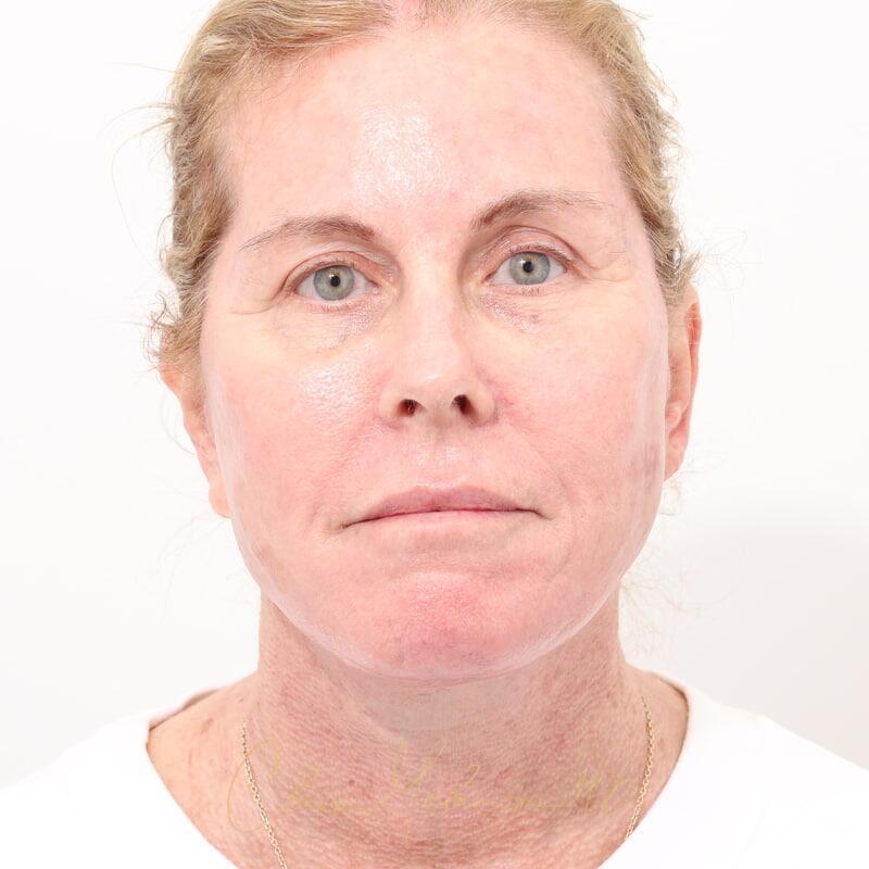 Facelift Before & After Photo