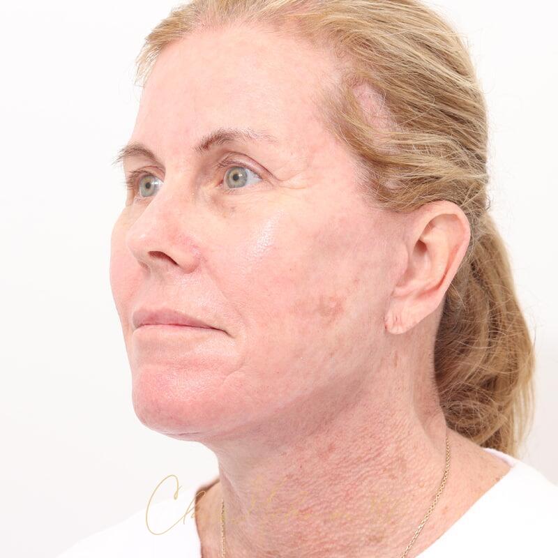 Facelift Before & After Photo