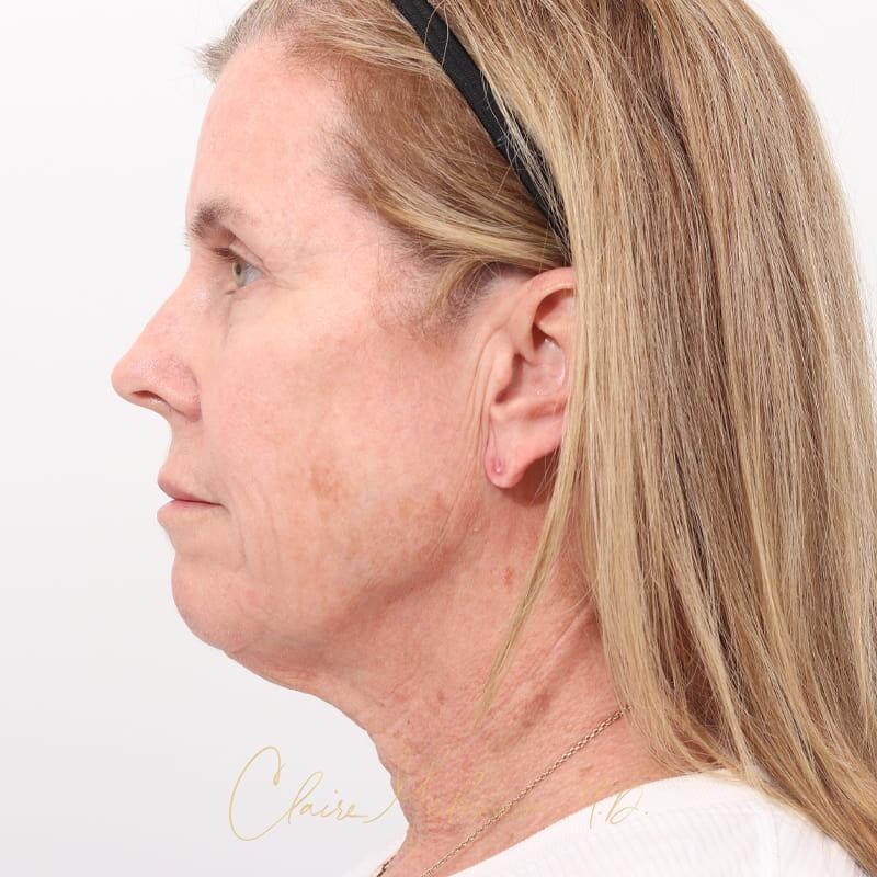 Facelift Before & After Photo