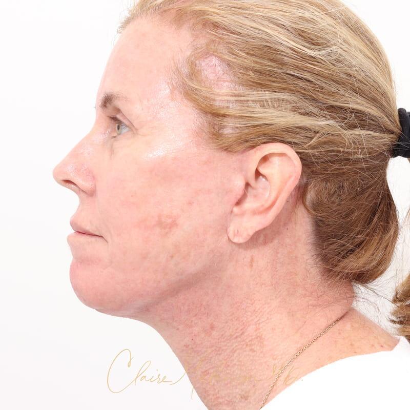 Facelift Before & After Photo