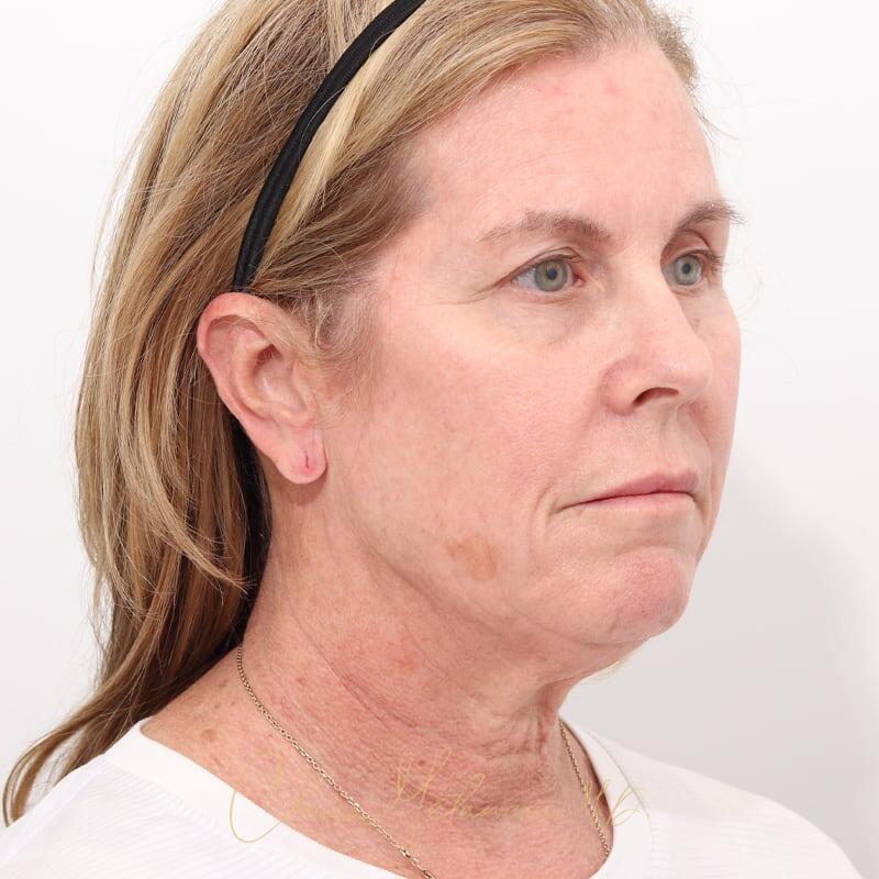 Facelift Before & After Photo