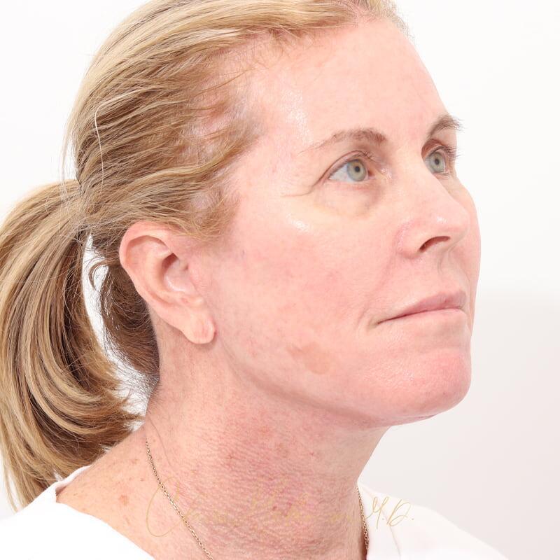 Facelift Before & After Photo