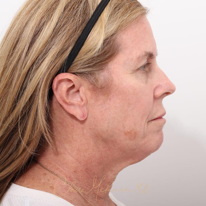 Facelift Before & After Photo