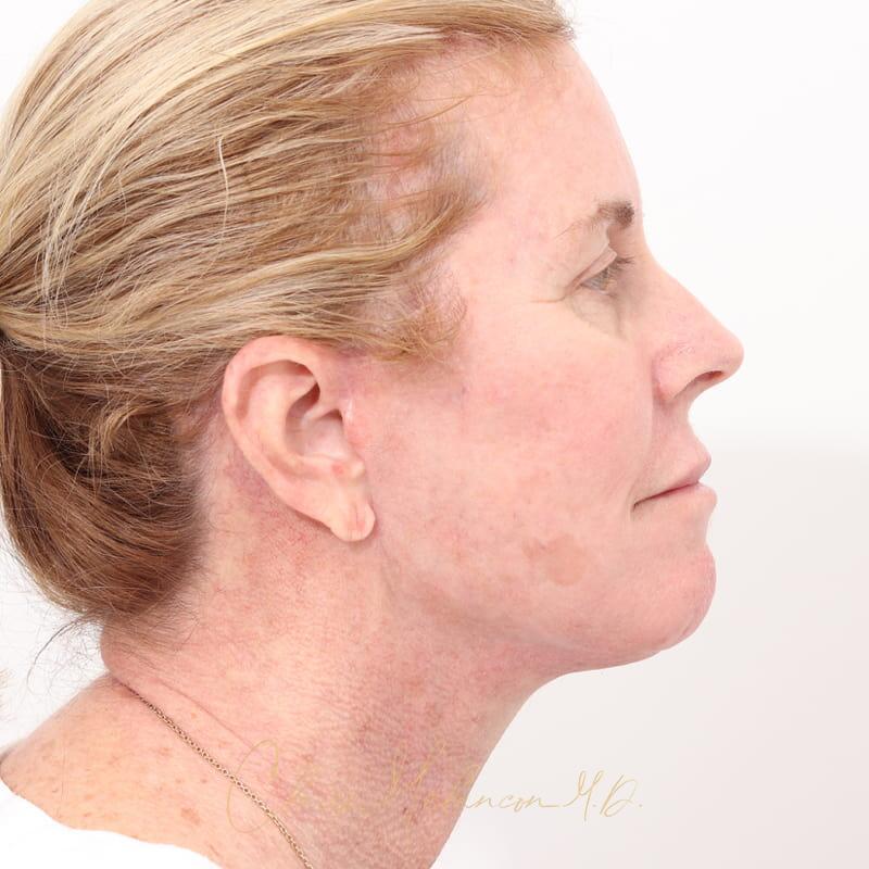 Facelift Before & After Photo